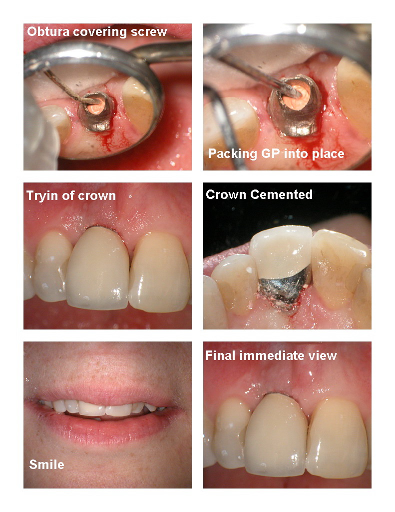 Implant pg 4.jpg